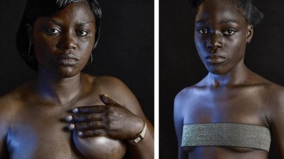 Tο “σιδέρωμα του μαστού”. Η βάρβαρη μέθοδος που υποβάλουν τα κορίτσια σε χώρες της Αφρικής για να πάψουν να είναι ελκυστικά και να μην πέφτουν θύματα σεξουαλικής κακοποίησης (φωτο και βίντεο)