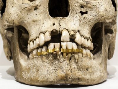 Εντυπωσιακά ευρήματα με αρχαία οδοντικά εμφυτεύματα που προέρχονταν από άλλους ανθρώπους και βόδια. Οι Ετρούσκοι ήταν οι πρώτοι που ασχολήθηκαν με την προσθετική οδοντιατρική και σταθεροποιούσαν τα δόντια με χρυσά ελάσματα
