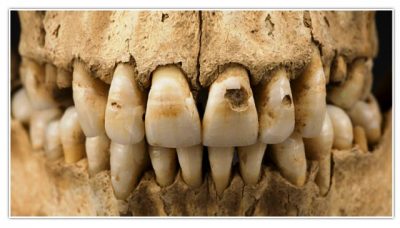 Τα δόντια ακόμη και σε σκελετούς εκατοντάδων ετών δίνουν πολλά στοιχεία για την υγεία και το επίπεδο πολιτισμού. Επιστήμονες που εξέτασαν δόντια του 18ου αιώνα, βρήκαν τα προβλήματα υγείας του κατόχου, όσο ζούσε