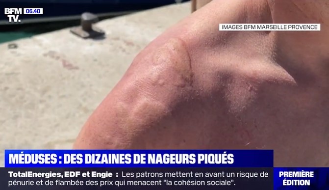 Μέδουσες σκόρπισαν τον τρόμο σε αγώνες κολύμβησης στη Γαλλία. Πάνω από 80 τα θύματα (Βίντεο)