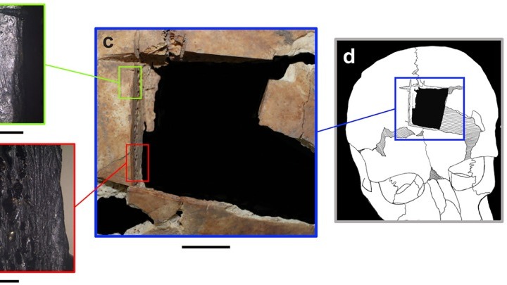 Βρέθηκε κρανίο με μια τετράγωνη τρύπα στο Ισραήλ. Επέμβαση εγκεφάλου πριν 3.500 χρόνια ή μετά θάνατον τελετουργικό;